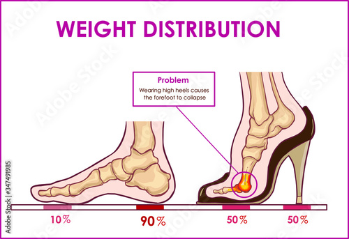 Vector illustration of  foot pain and weight distribution by wearing high heels