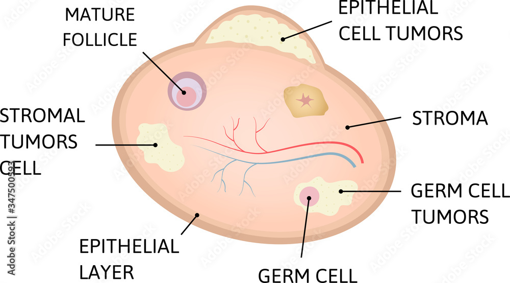 Obraz premium Ovarian cancer. cancer of epithelial layer, germ cell, stromal tumors cell.