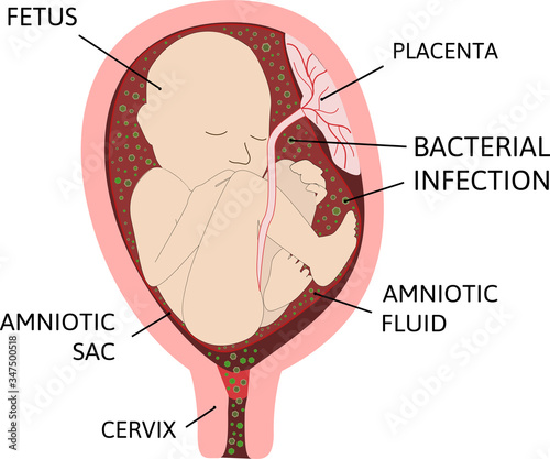 Chorioamnionitis or intra-amniotic infection IAI is an inflammation of the fetal membranes amnion and chorion due to a bacterial infection.