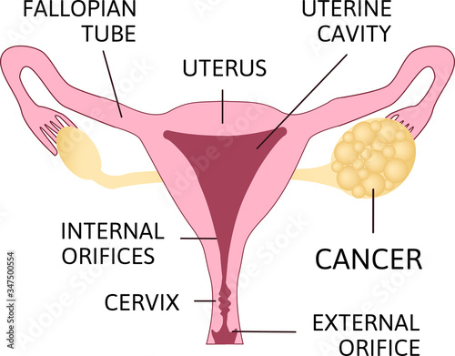 Ovarian Cancer. Ovarian carcinoma, germ cell tumor, sex cord stromal tumor.