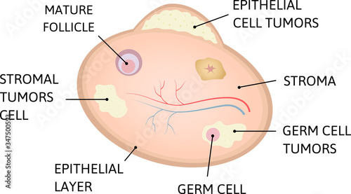 Ovarian cancer. cancer of epithelial layer, germ cell, stromal tumors cell.