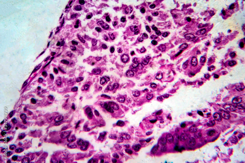 Endometrial adenocarcinoma, light micrograph, photo under microscope ...