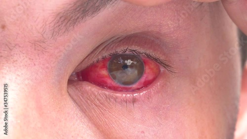 Close up of two annoyed red blood eyes of male affected by conjunctivitis or after flu, cold, allergy. Red eye. damaged eye. Blood in the eye. Eyes close up. Sore eye. Mschina with a sore eye photo
