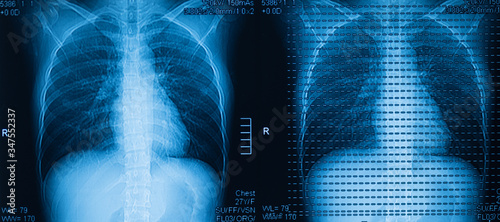 Whole abdomen MRI scan (Magnetic Resonance Image) High resolution.Human film x-ray chest image. Radiology image for medical treatment. photo