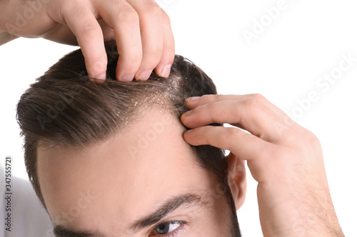 Man with dandruff in his hair on white background, closeup photo