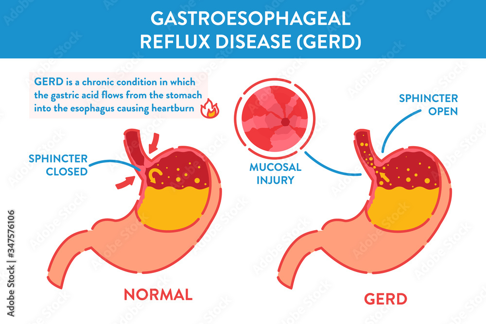 Gastroesophageal Reflux Disease Infographic Banner Endoscopic Image Of 