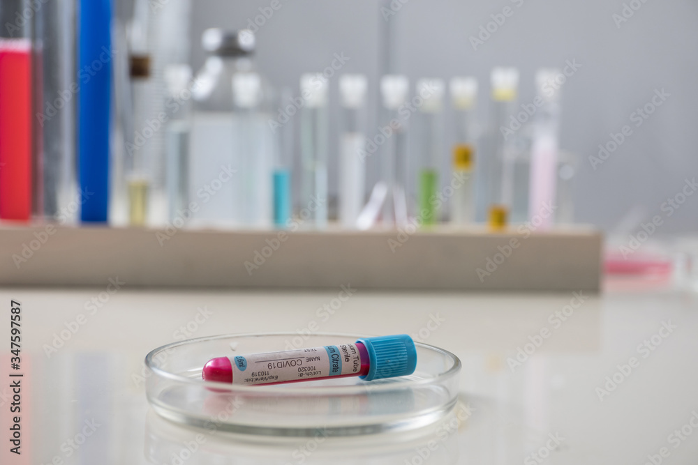 Positive blood test result for the new rapidly spreading Coronavirus, originating in Wuhan, China Positive blood test result for the new rapidly spreading Coronavirus, originating in Wuhan, China