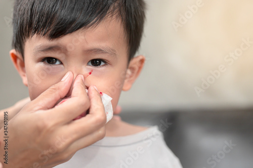 Portrait of cute Asian ethnic child having nosebleed,The concept of first aid for nosebleeds. photo