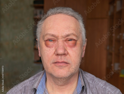 A man with swollen eyes. Allergies to medications.
