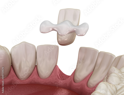 фотографія Maryland bridge made from ceramic, front tooth recovery