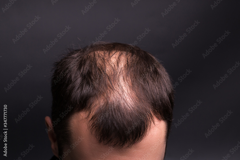 Male head close-up with baldness. Studio black background. Male head close-up with baldness. Studio black background.