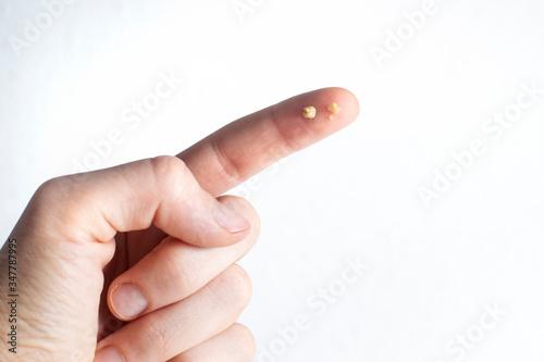 Tonsillolith (caseum) on index finger isolated on white background. Tonsil stones are hard deposits of debris that have lodged in tonsils.