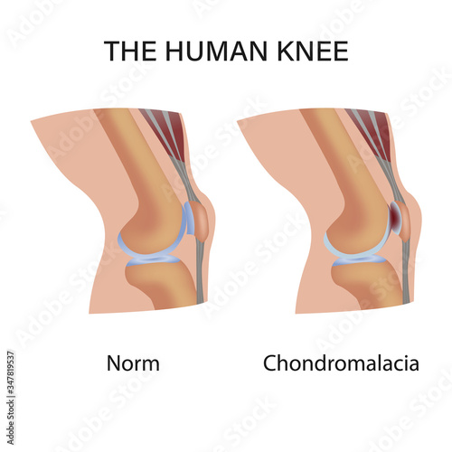 Chondromalacia. Pain in the joint. degenerative joint disease. The cartilage becomes worn out. This leads to inflammation, swelling, and joint pain.