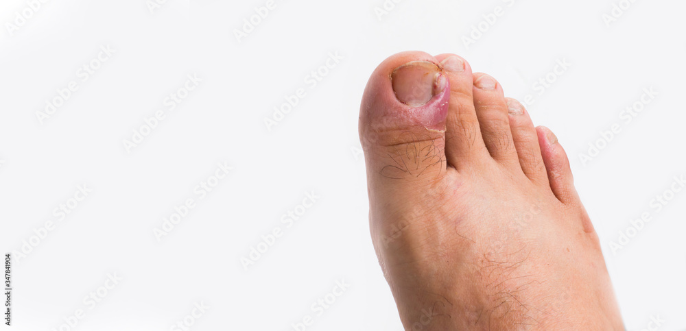 Close up of ingrown toenail is Inflamed fingernails isolated on white background. Health care and Foot disease concept Close up of ingrown toenail is Inflamed fingernails isolated on white background. Health care and Foot disease concept