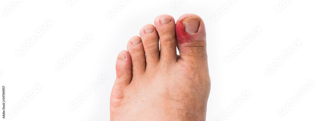 Close up of ingrown toenail is Inflamed fingernails isolated on white background. Health care and Foot disease concept Close up of ingrown toenail is Inflamed fingernails isolated on white background. Health care and Foot disease concept