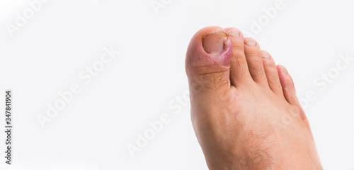 Foto Close up of ingrown toenail is Inflamed fingernails isolated on white background