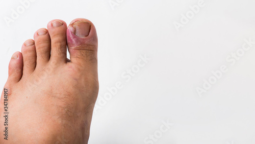 Close up of ingrown toenail is Inflamed fingernails isolated on white background. Health care and Foot disease concept photo