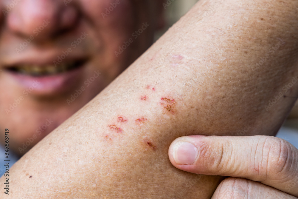Person embracing wound on skin a result of scratching due to itchy allergy