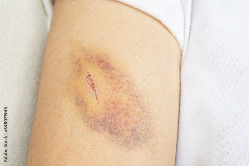 Accidental bruises on the upper arm and wrinkles, skin inflammation. Accidental bruises on the upper arm and wrinkles, skin inflammation.