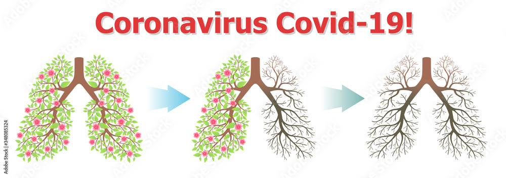 Plakat Coronavirus. Stages of pneumonia