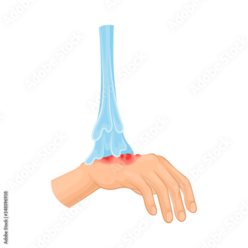 First Aid for Hand with Ambustion or Burn on the Skin Vector Illustration