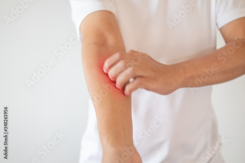 man itching and scratching on arm from itchy dry skin eczema dermatitis © Piman Khrutmuang