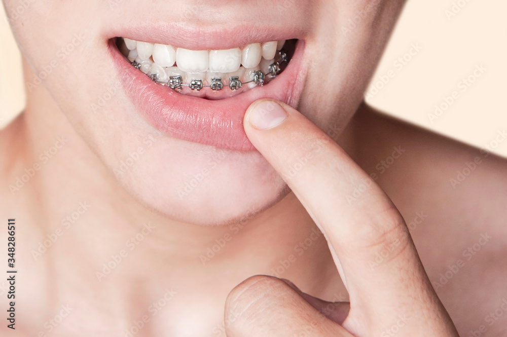 Fototapeta premium A young man points a finger at the braces on his teeth. Dental concept