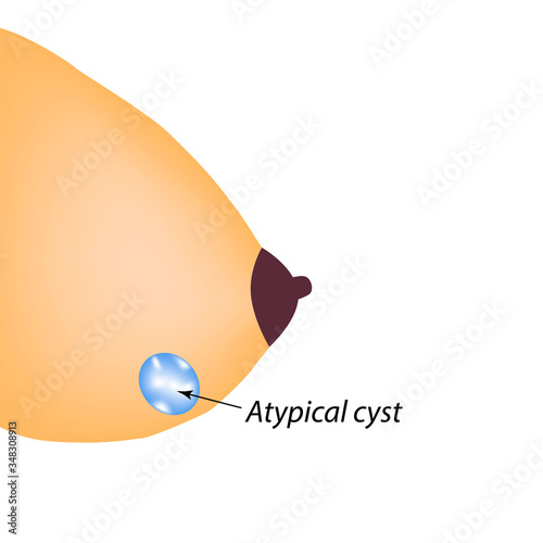 Atypical cyst of the breast. Mammary gland. World Breast Cancer Day. Vector illustration on isolated background