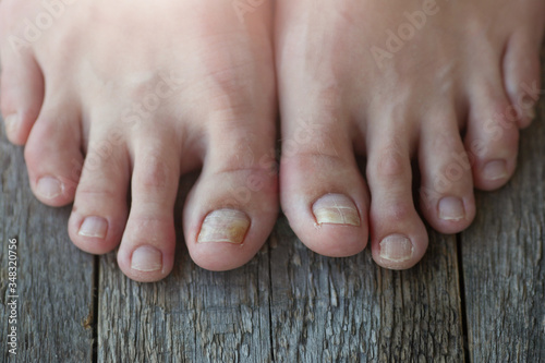 Onycholysis: exfoliation of the nail from the nail bed. photo