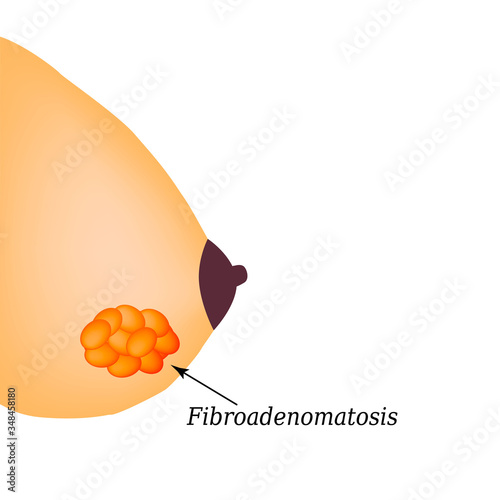 Fibrooadenomatosis in the mammary gland. World Breast Cancer Day. Vector illustration on isolated background