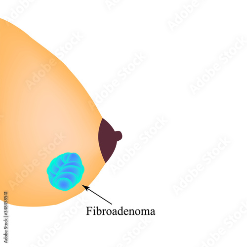 Fibroadenoma in the mammary gland. World Breast Cancer Day. Vector illustration on isolated background