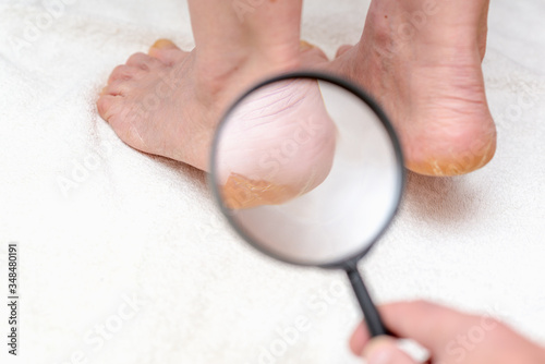 Close up image through a magnifying glass dry woman heels fungus on a white background.