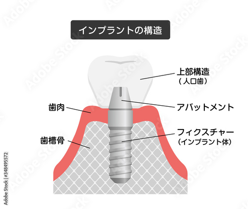 インプラントの仕組み・構造　断面図イラスト 