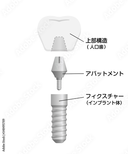インプラントの仕組み・構造　断面図イラスト 