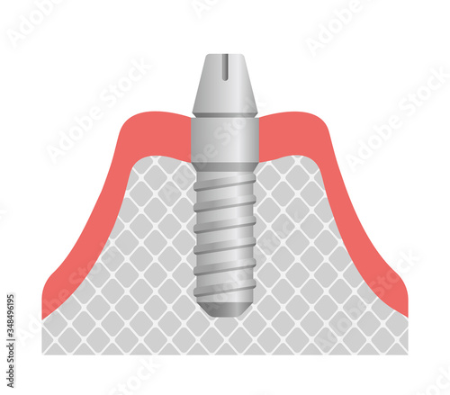 Dental implant flat vector illustration / Attach abutment
