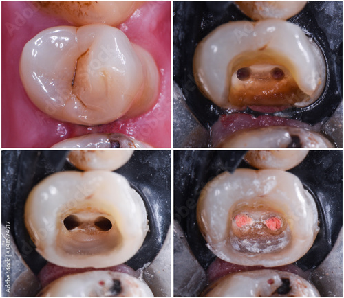 root canal treatment under dental microscope photo