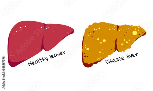 Healthy and disease liver vector illustration. Cartoon unhealthy organ medical banner. Internal ilness design element. photo