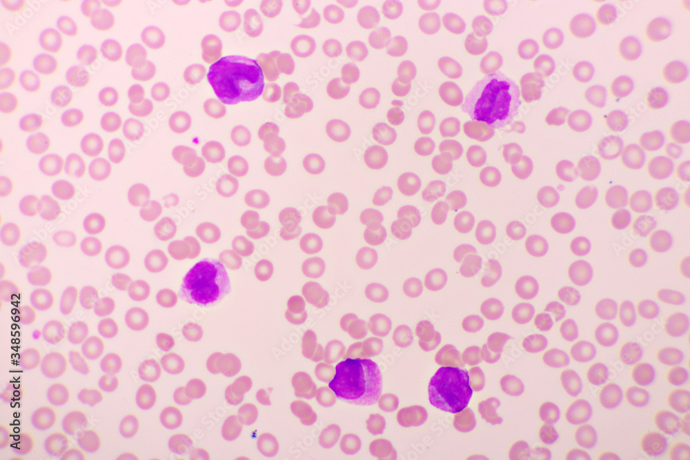 Acute promyelocytic leukemia cells or APL, analyze by microscope, original magnification 1000x