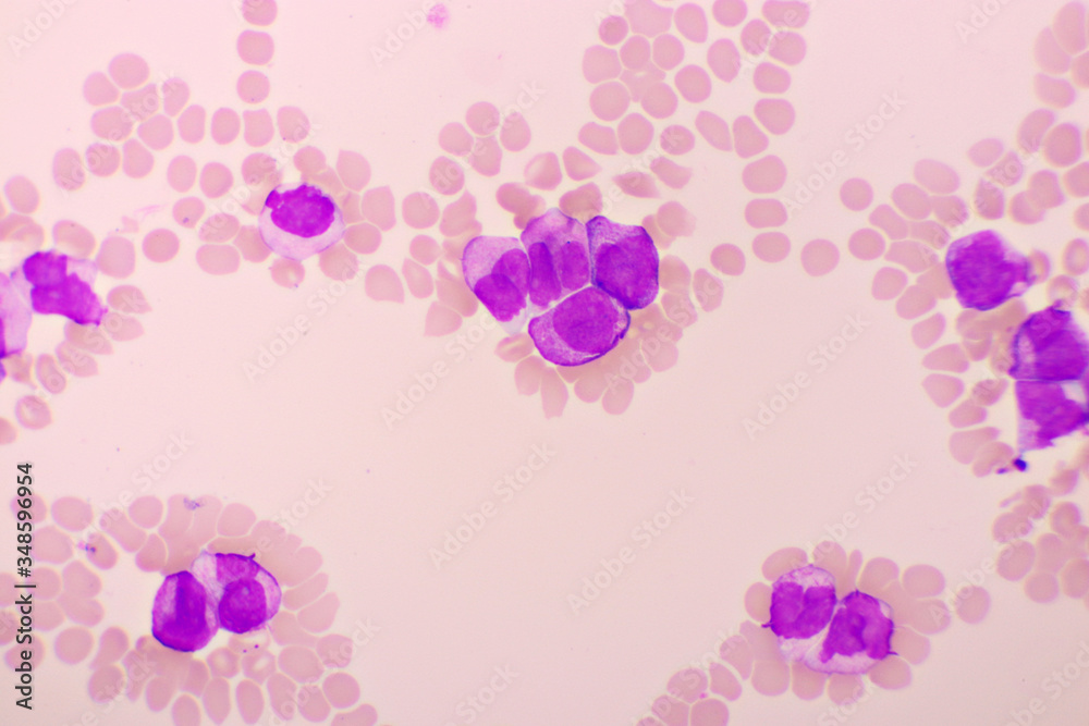 Acute promyelocytic leukemia cells or APL, analyze by microscope, original magnification 1000x