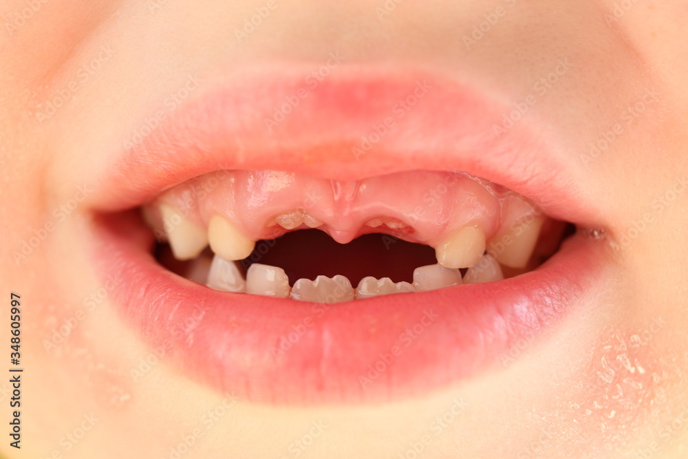 Naklejka premium Smile baby girls. Loss of front upper milk teeth and growth of new adult incisor, molar. Oral care in children. Dryness and peeling of skin around and in corners of mouth.