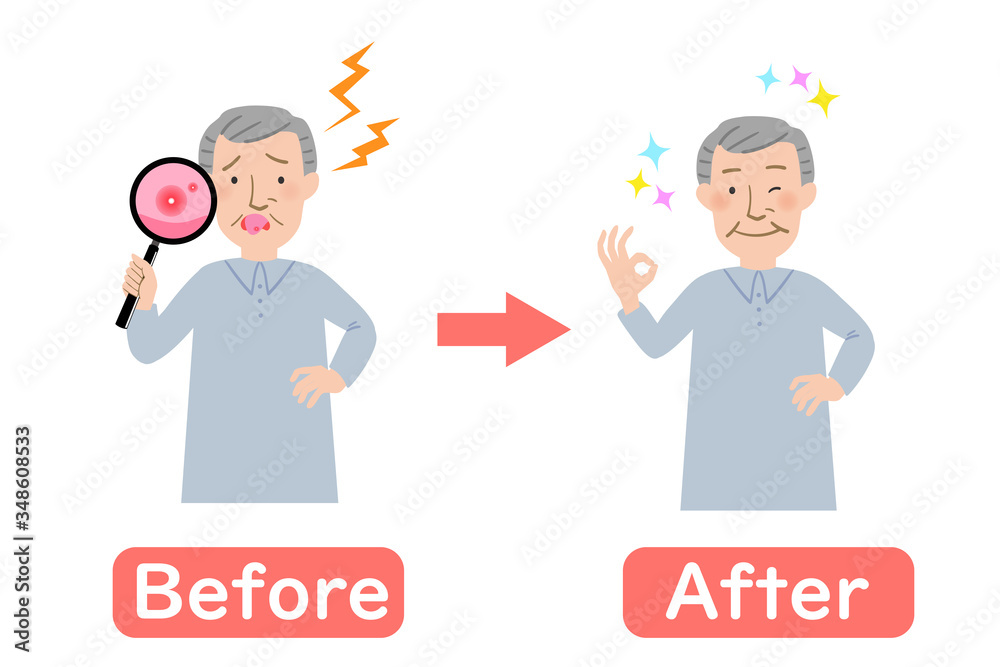 口内炎に悩むおじいちゃんのビフォーアフター 口内炎に悩むおじいちゃんのビフォーアフター