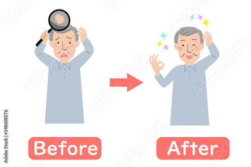 頭の薄毛に悩むおじいちゃんのビフォーアフターベクターイラスト