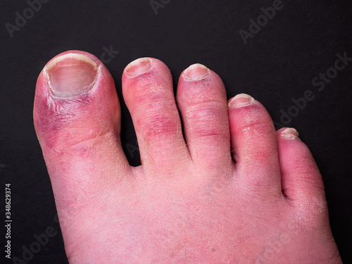 Tableau sur toile A man's toes showing what looks like a rash with red blotchy skin