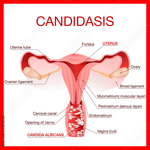 Vaginal yeast infection. Candidiasis. Gynecological medical disease infographic.