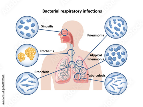 Bacterial respiratory infections: sinusitis, tracheitis, bronchitis, pneumonia, Atypical pneumonia, tuberculosis. Microbiology. Bacteria in magnifying glass. Vector illustration in flat style photo