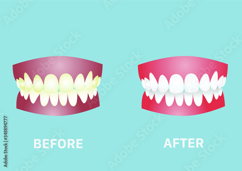 Tooth model