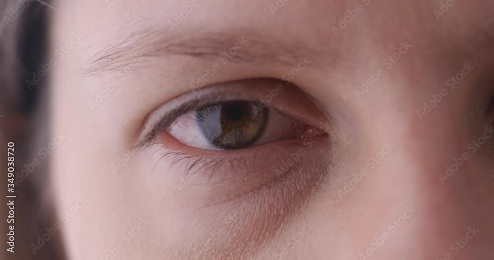 Close-up of woman sick eye that was infected by some kind of allergen. Eyeball with red vein that itches. Blinking Eye of patient with corona virus. Close-up of woman sick eye that was infected by some kind of allergen. Eyeball with red vein that itches. Blinking Eye of patient with corona virus.