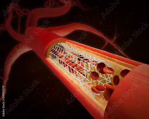 3D illustration of a bypass stent - chronic coronary heart disease