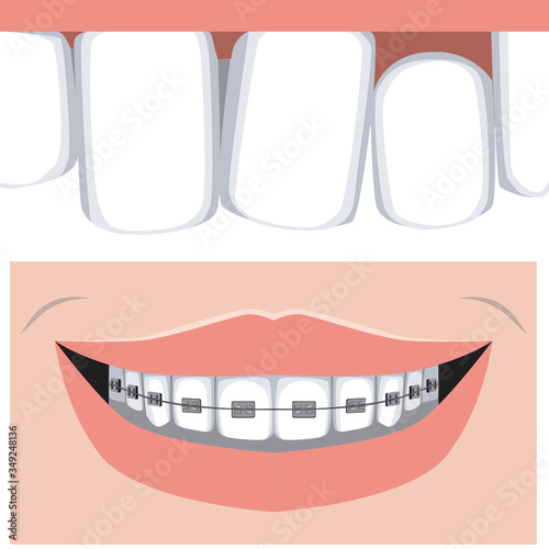 Teeth and malocclusion on the upper jaw, flat vector stock illustration with molars and incisors and braces as a concept of dental treatment