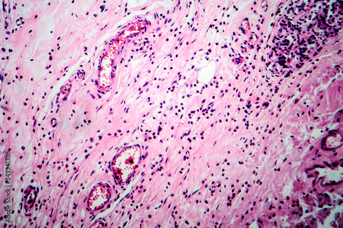 Breast fibroadenosis, light micrograph photo